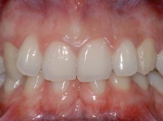 denti-1