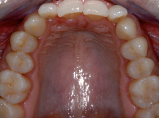 denti-2