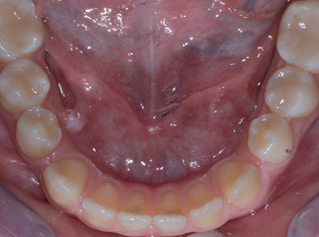 denti-3