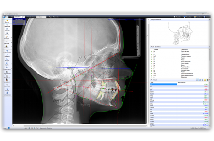 tracciato cefalometrico